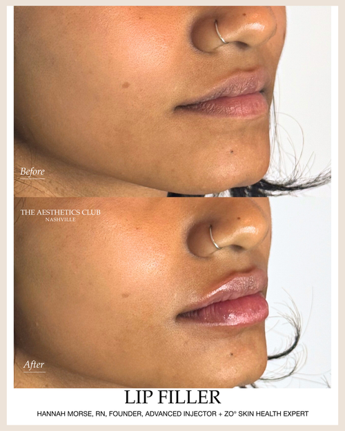 Lip Filler before and after by Hannah Morse Cuffman RN