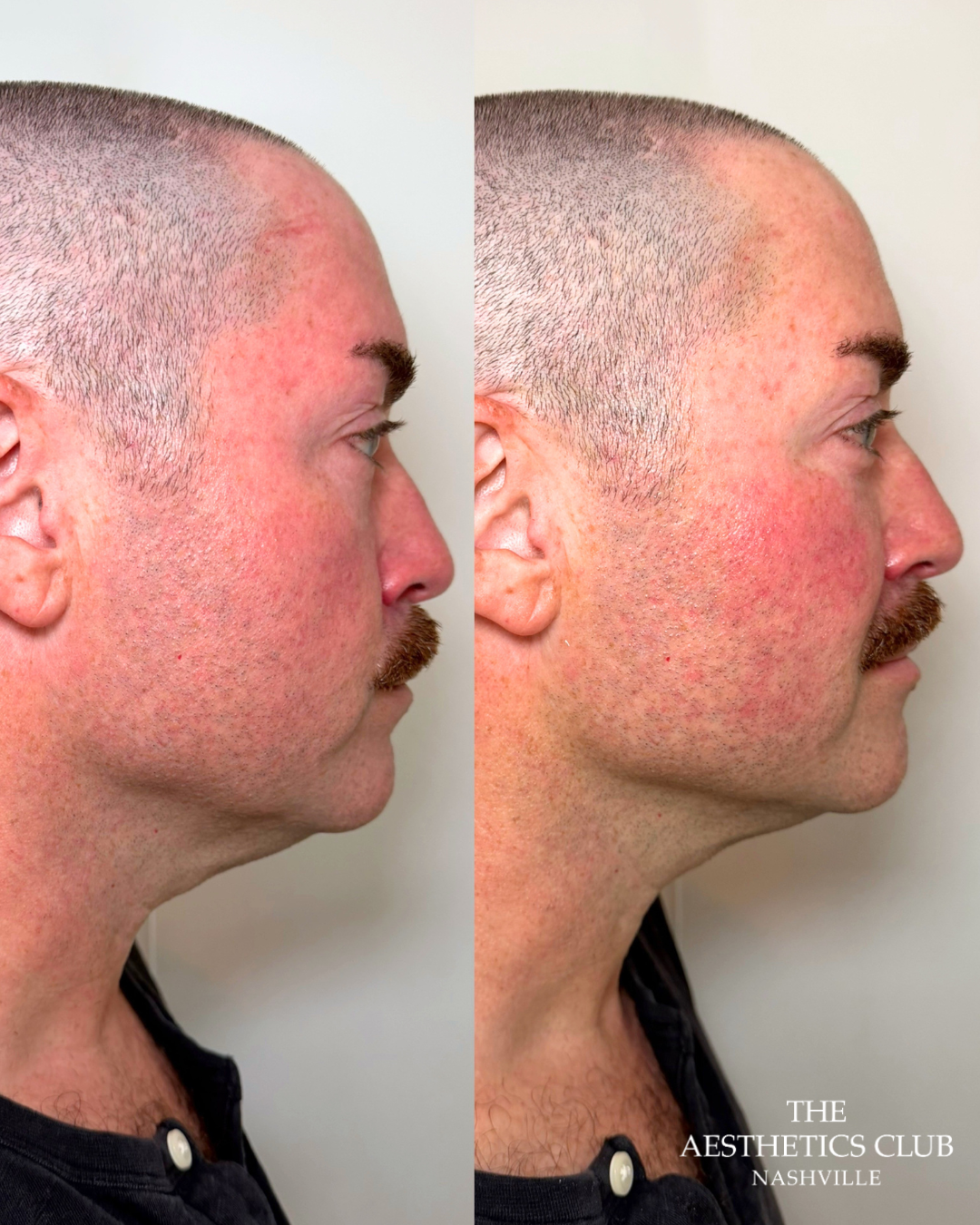 Man before and immediately after one EVERESSE treatment showing improved jawline definition and facial firmness