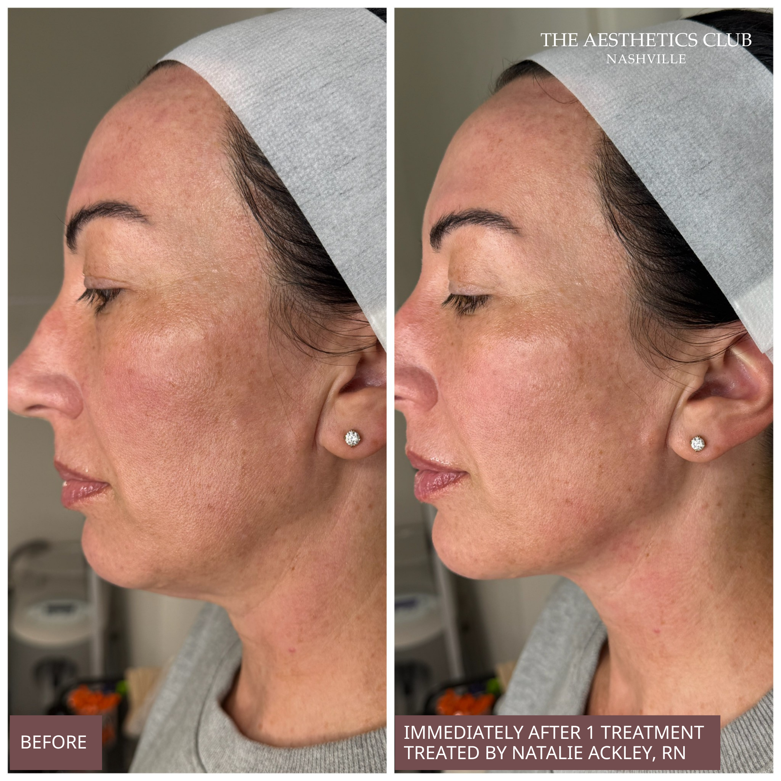 Before and immediately after EVERESSE Skin Tightening treatment showing improved jawline definition and skin tightening using radiofrequency technology at The Aesthetics Club Nashville.