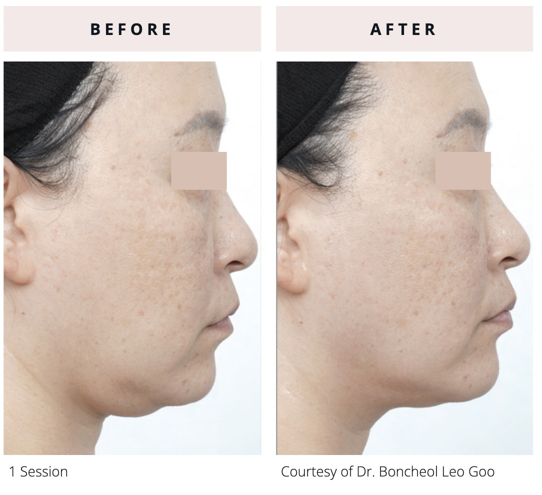 Side-profile before and after of EVERESSE skin tightening after 1 session showing improvement in jawline contour, skin laxity, and overall facial definition with smoother-looking skin.
