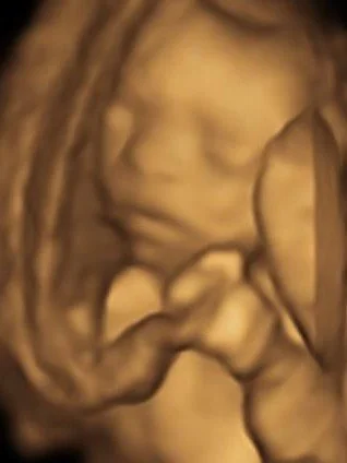 3D ultrasound image showing baby's face, upper body, and hands.