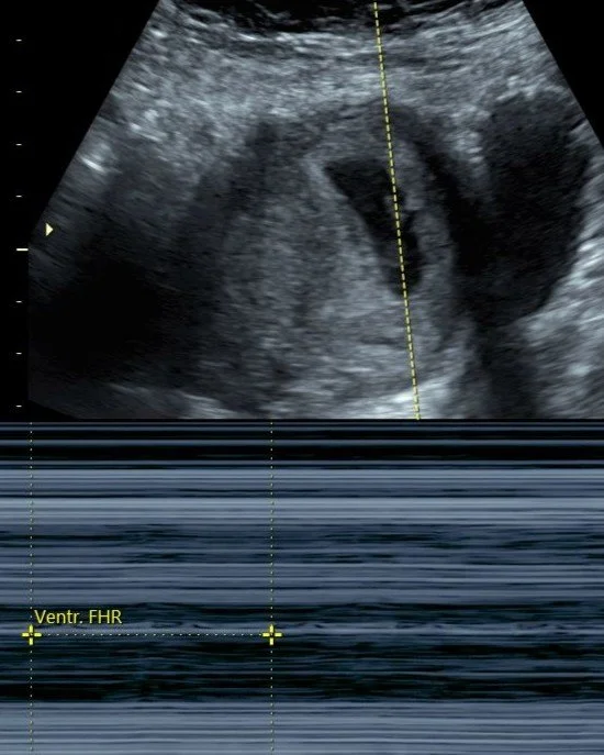 Ultrasound image showing a developing fetus inside the womb.