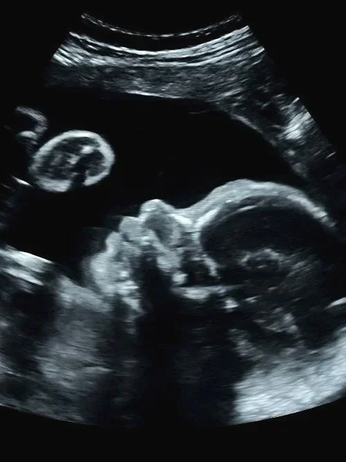 Ultrasound image of a developing fetus inside the womb.