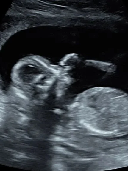 Ultrasound image of a fetus in the womb.