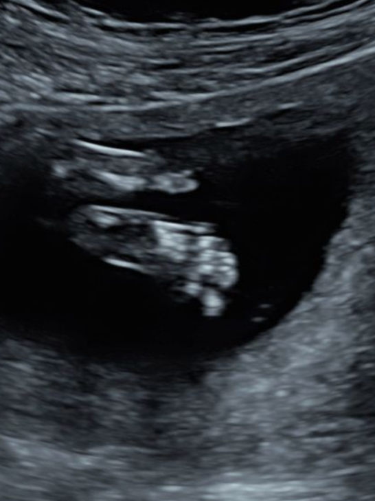 Ultrasound image of a developing fetus inside the womb.