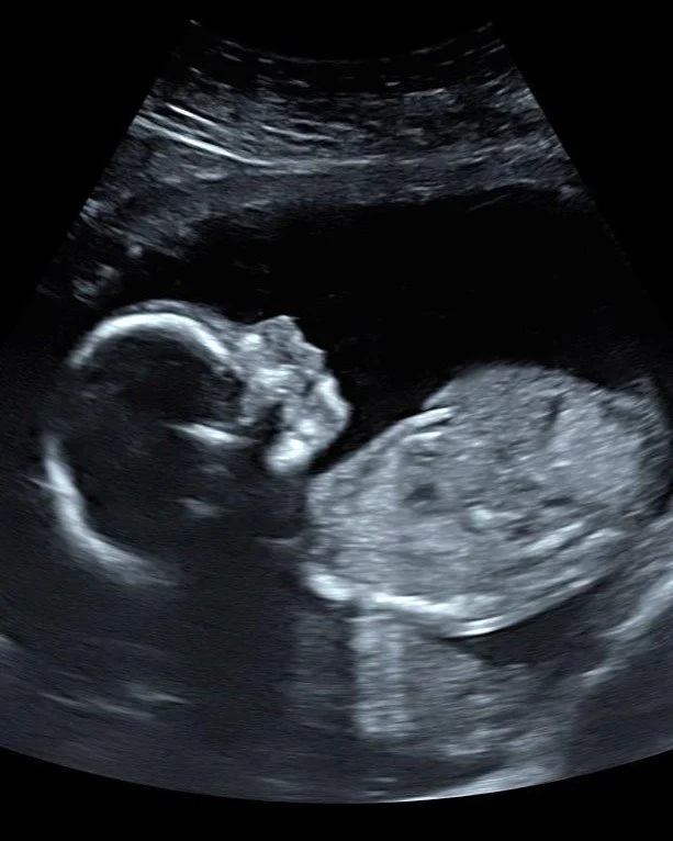 Early pregnancy ultrasound for reassurance and checking in on baby's development.