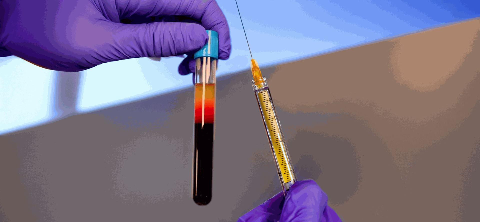 ezgel system showing a vial of platelet rich plasma