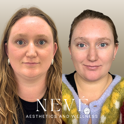 Full Face Treatment + Masseter Tox