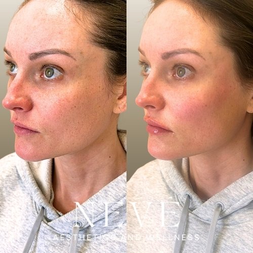 FILLER - Facial Balancing 3 (2).jpg