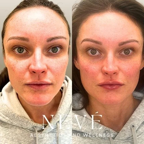 FILLER - Facial Balancing 3.jpg