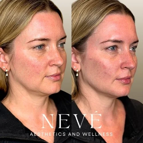 FILLER - Facial Balancing 2.jpg