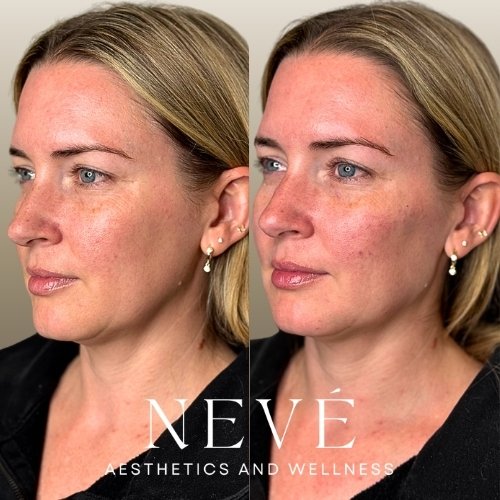 FILLER - Facial Balancing 1.jpg