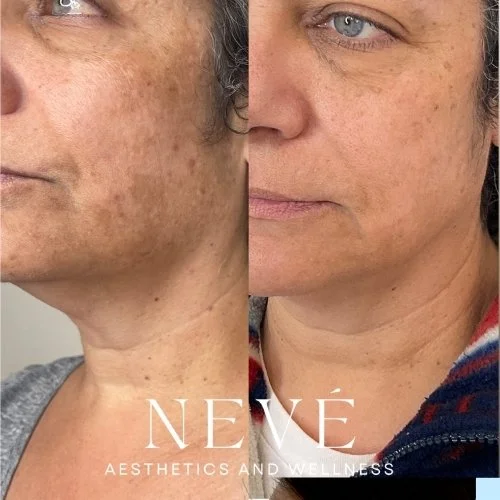 Sun Damage &amp; Pigment Correction