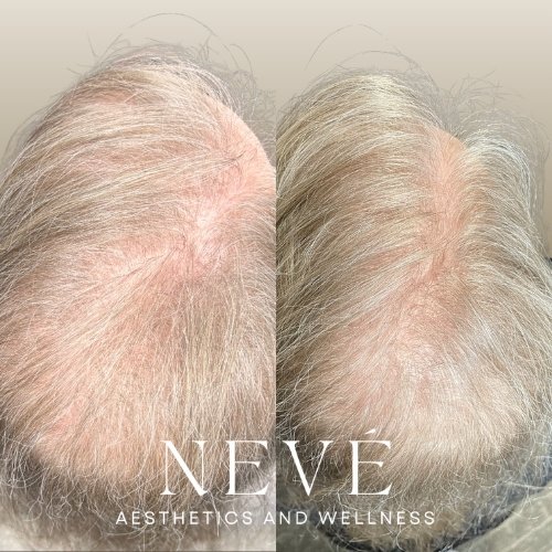 Hair Restoration with Keralase™