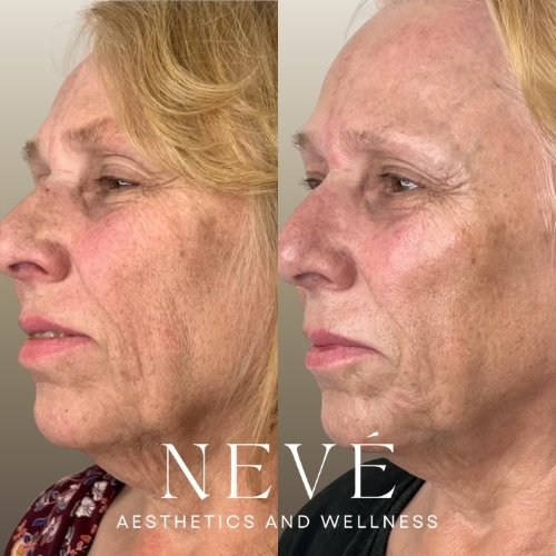 RF Microneedling - 1.jpg