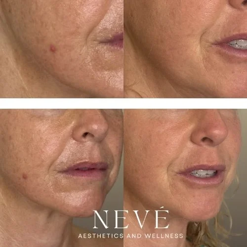 Traditional TSS - Brighter, More Even Skin