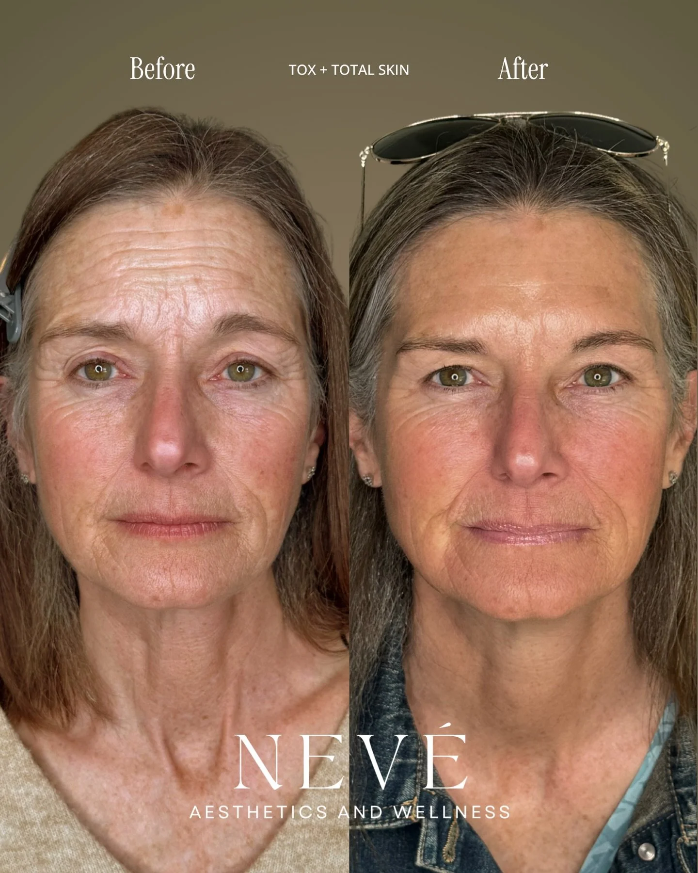 The best results are built.

Tox softens expression lines. A Total Skin series improves tone, addresses years of sun damage, and stimulates collagen for healthier, more radiant skin.

The secret isn&rsquo;t doing everything at once&mdash;it&rsquo;s m
