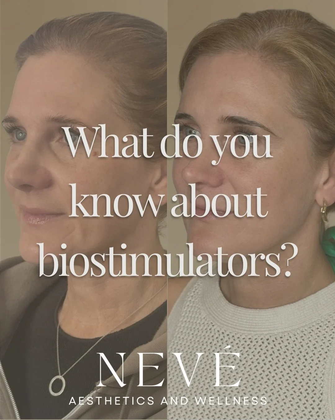 Filler is for instant gratification. Sculptra&reg; is for the long game.

And there&rsquo;s a place for both.

Sometimes the best treatment plan includes filler for immediate volume restoration, paired with Sculptra&reg; to stimulate collagen and bui