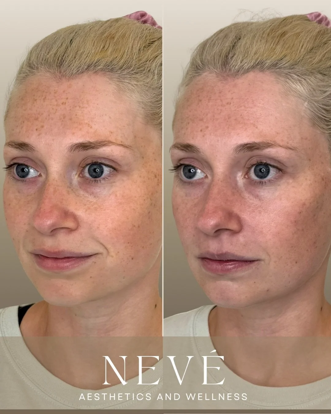 Facial balancing isn&rsquo;t always about adding back what&rsquo;s been lost with age or weight loss. Sometimes, it&rsquo;s simply about creating more harmony between the features you already have.

We hear so many different goals from our patients &