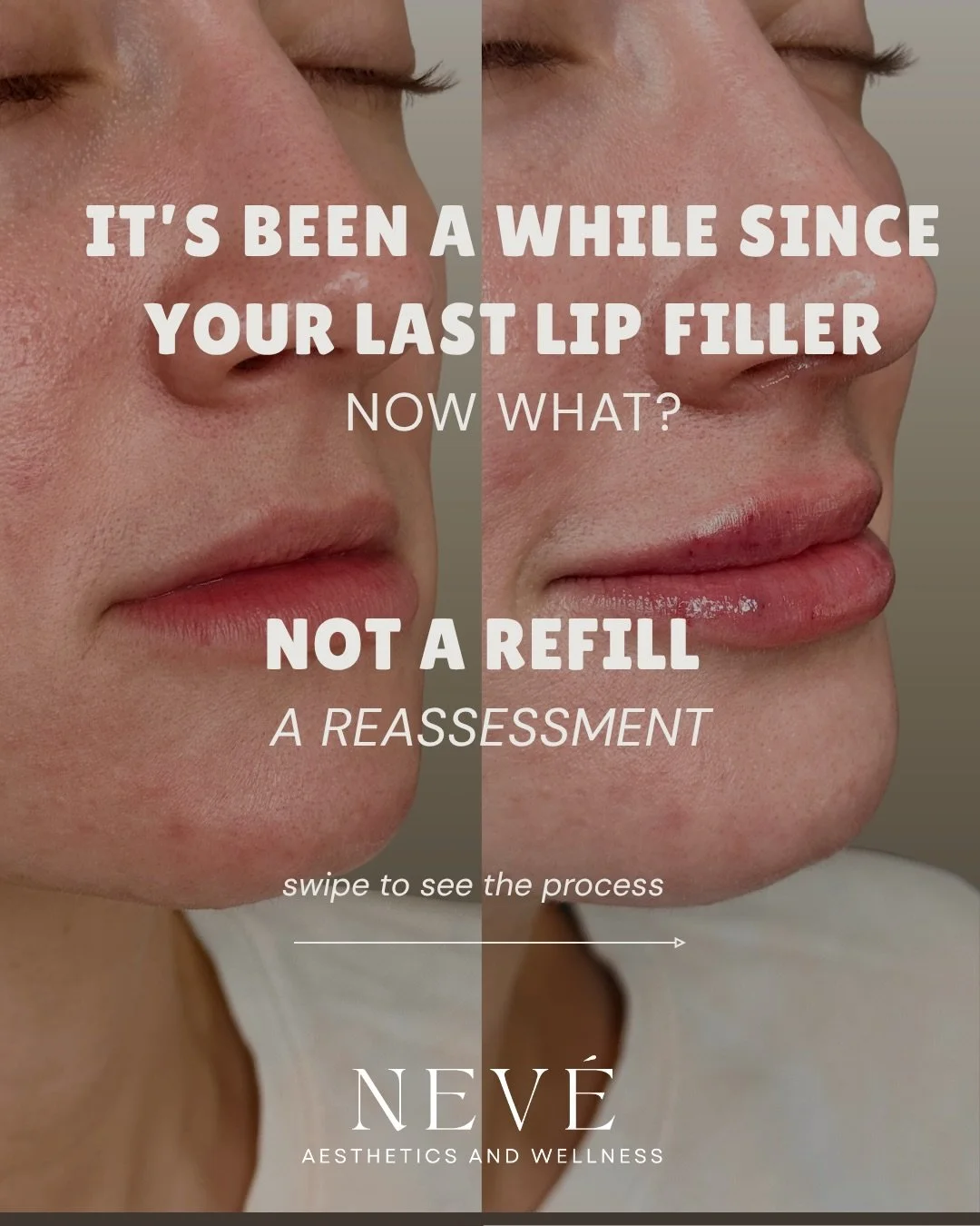 It&rsquo;s been a while since your last lip filler appointment. What now?

Maybe you loved your result. Maybe you didn&rsquo;t. Maybe your lips have simply changed over time and you&rsquo;re not sure what the next step should be.

Filler settles, you