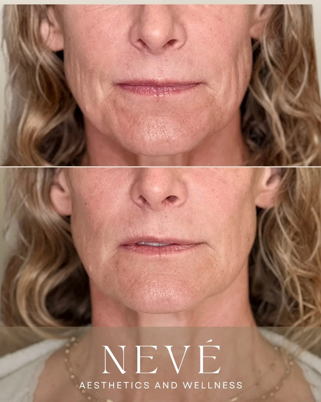 A little more structure. A little more lift. Still completely her.

This is her result after one cheek filler treatment, thoughtfully placed to bring her vision to life while keeping everything balanced and natural.

Sometimes you know exactly what y