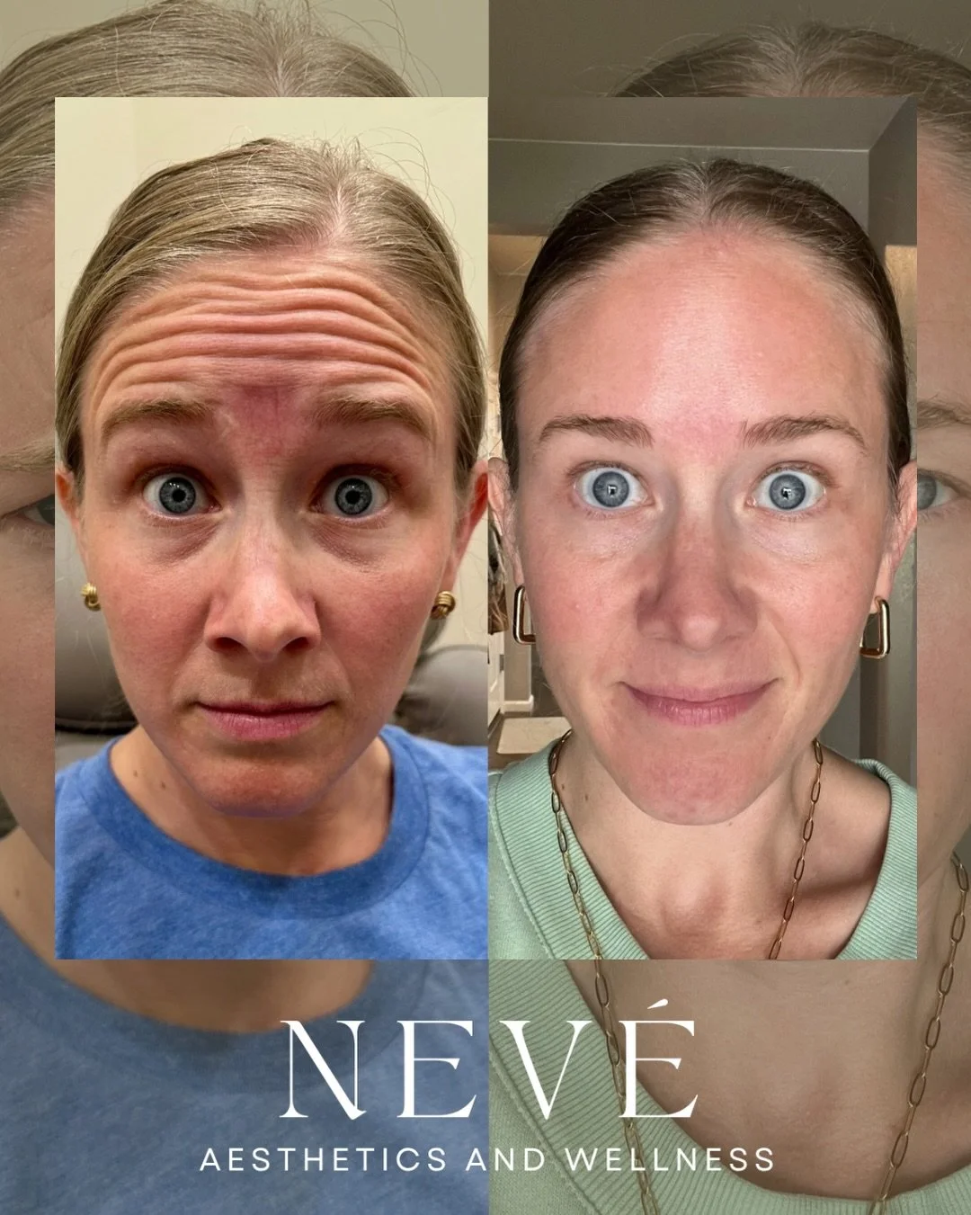 There&rsquo;s a reason tox is one of our favorites. ✨

Beautiful, expressive, and completely herself.

Because the goal was never to take away what makes her her &mdash; just to help her feel a little more refreshed. 🤍

We typically recommend schedu