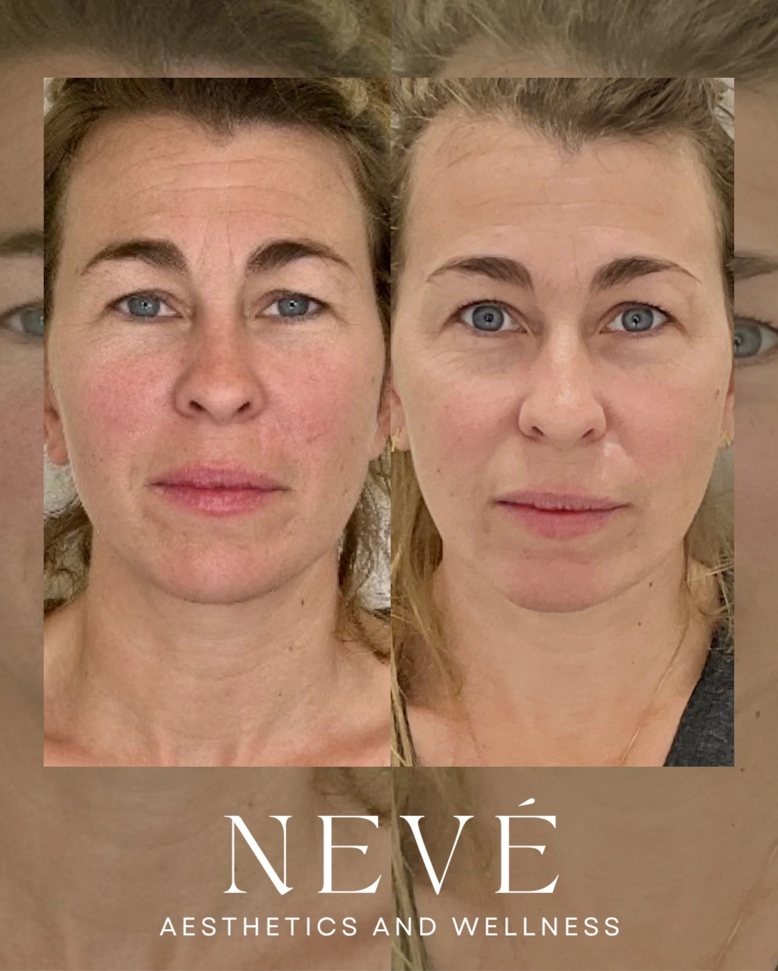 The best tox doesn&rsquo;t make you look different. It just makes you look refreshed. ✨

We want you to keep your expression, your personality, and the things that make your face yours.

Pairing tox with a good at-home skincare routine is a great pla