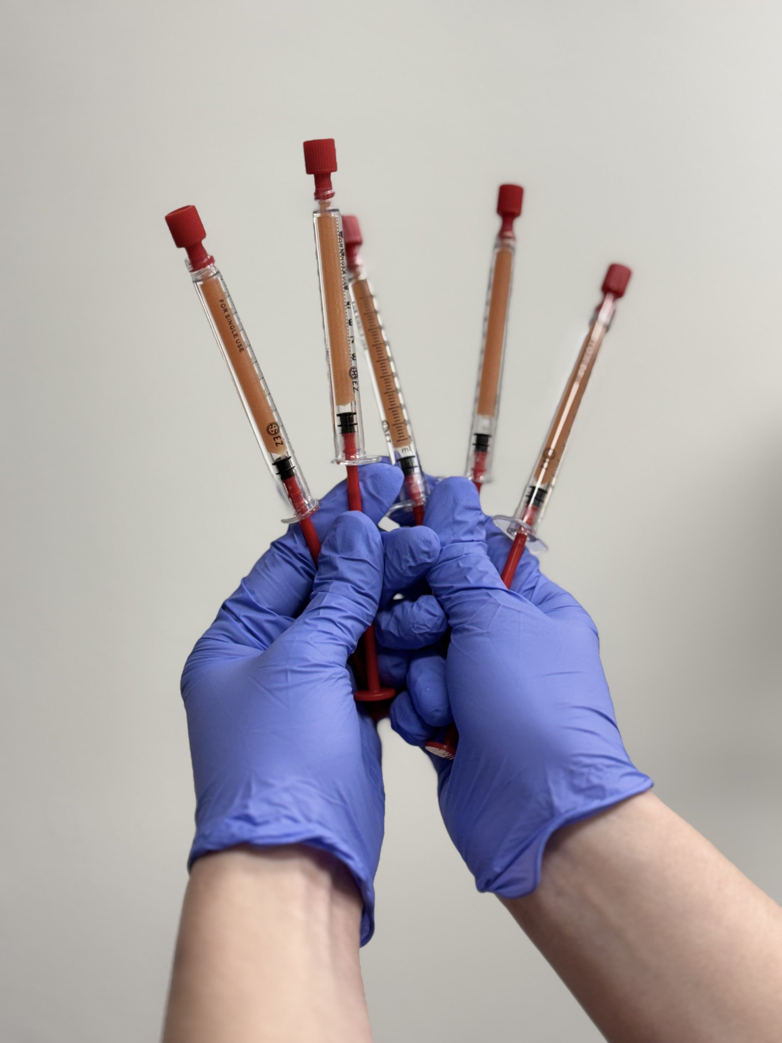 blue gloved hands holding multiple syringes of platelet rich fibrin and platelet rich plasma