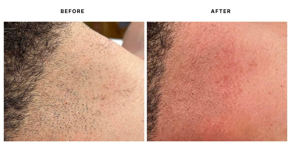  Before and after laser hair removal results at Laser &amp; Skin Medical in Edgewater, Miami 