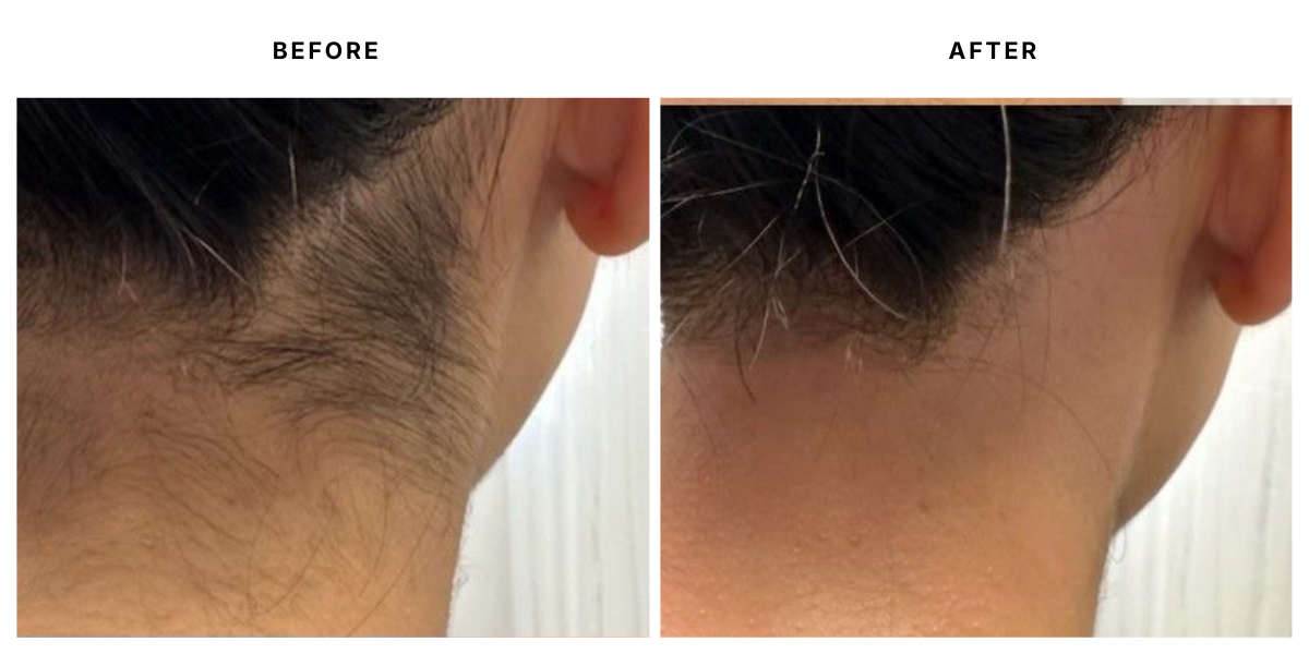  Before and after laser hair removal results at Laser &amp; Skin Medical in Edgewater, Miami 