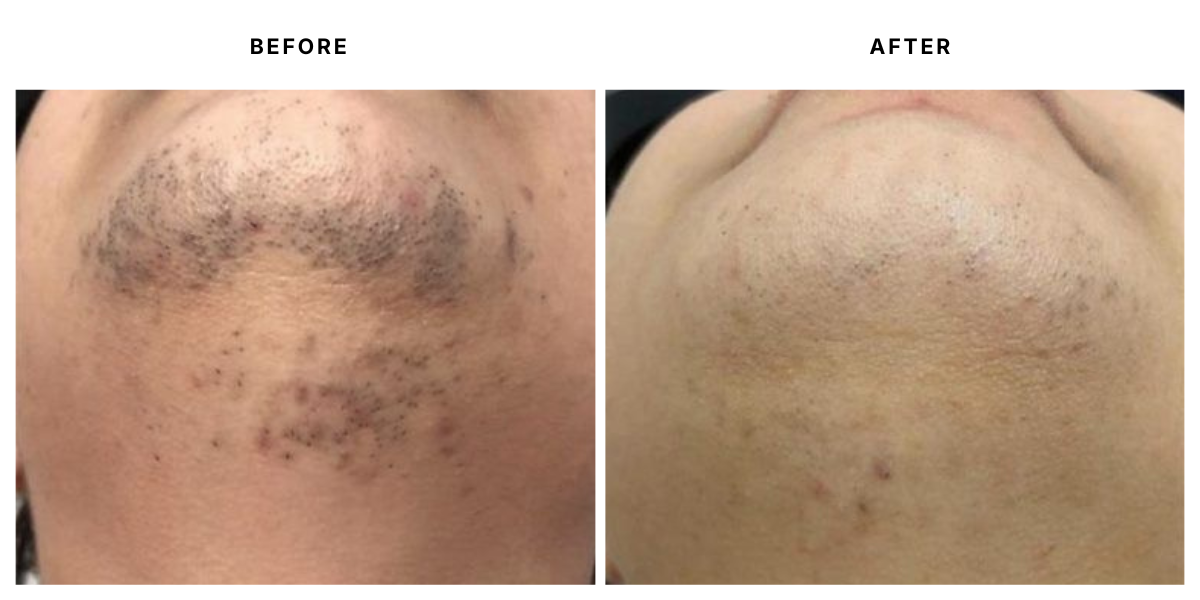  Before and after laser hair removal results at Laser &amp; Skin Medical in Edgewater, Miami 