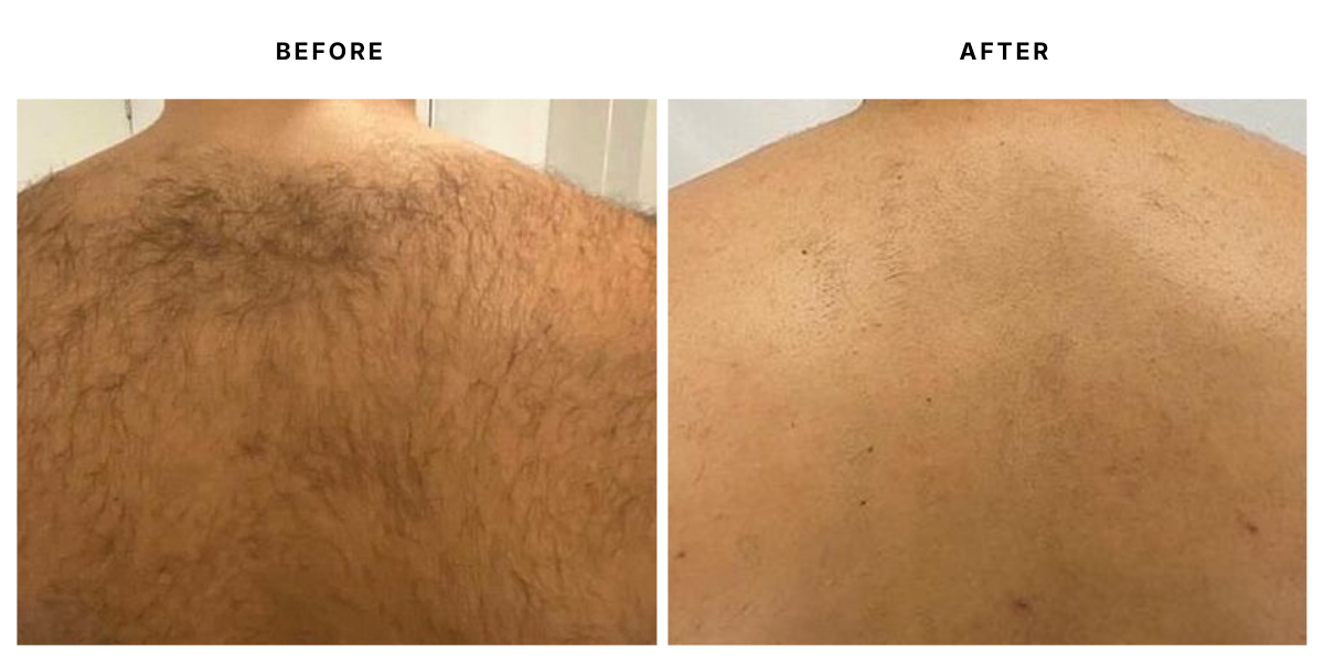  Before and after laser hair removal results at Laser &amp; Skin Medical in Edgewater, Miami 