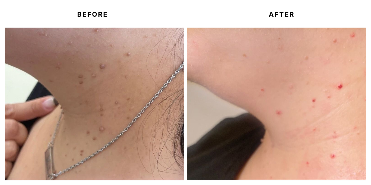  Before and after skin treatment results at Laser &amp; Skin Medical in Edgewater, Miami 