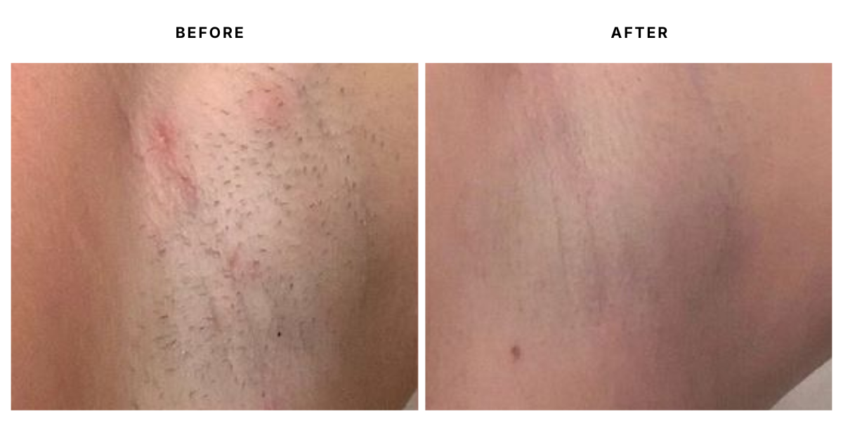  Before and after laser hair removal results at Laser &amp; Skin Medical in Edgewater, Miami 