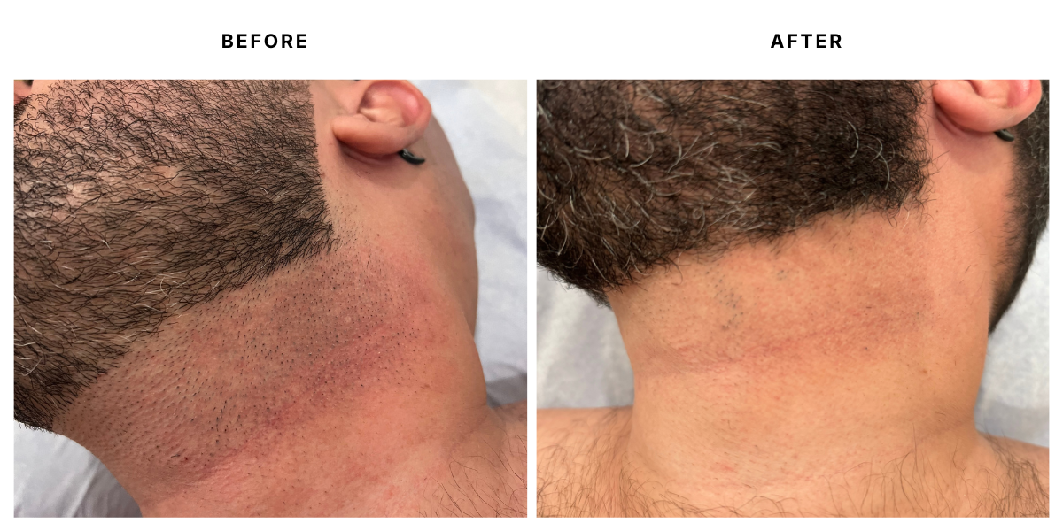  Before and after laser hair removal results at Laser &amp; Skin Medical in Edgewater, Miami 
