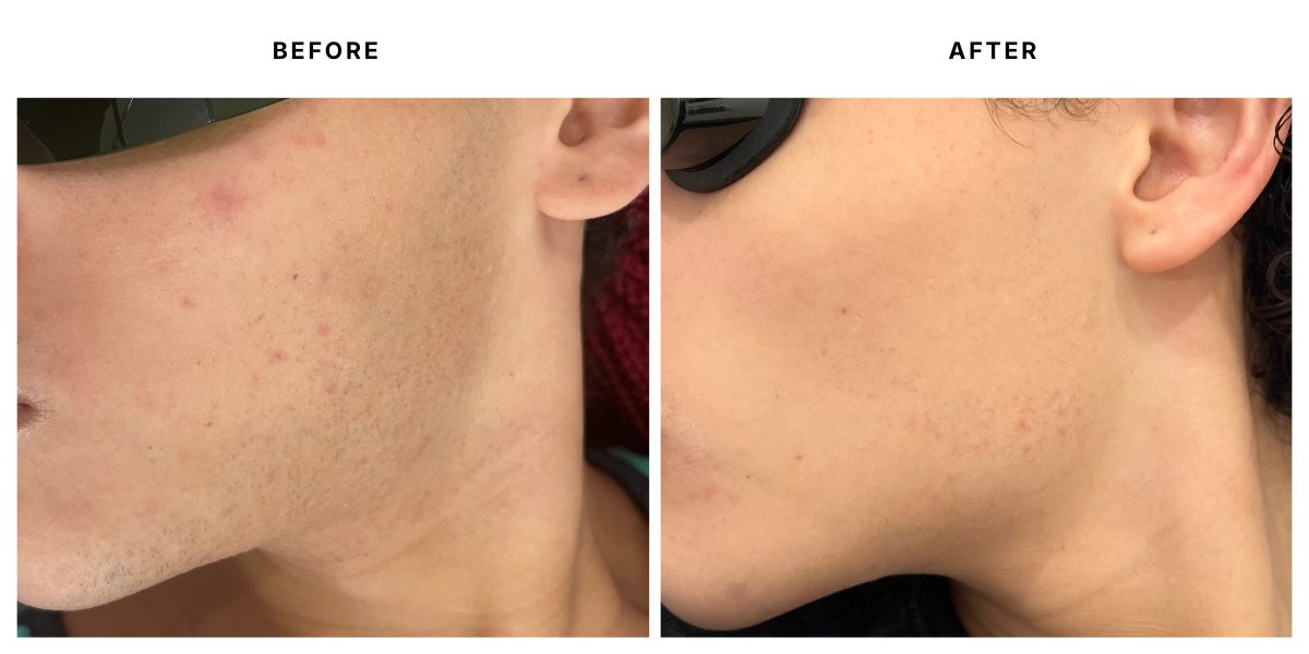  Before and after laser hair removal results at Laser &amp; Skin Medical in Edgewater, Miami 