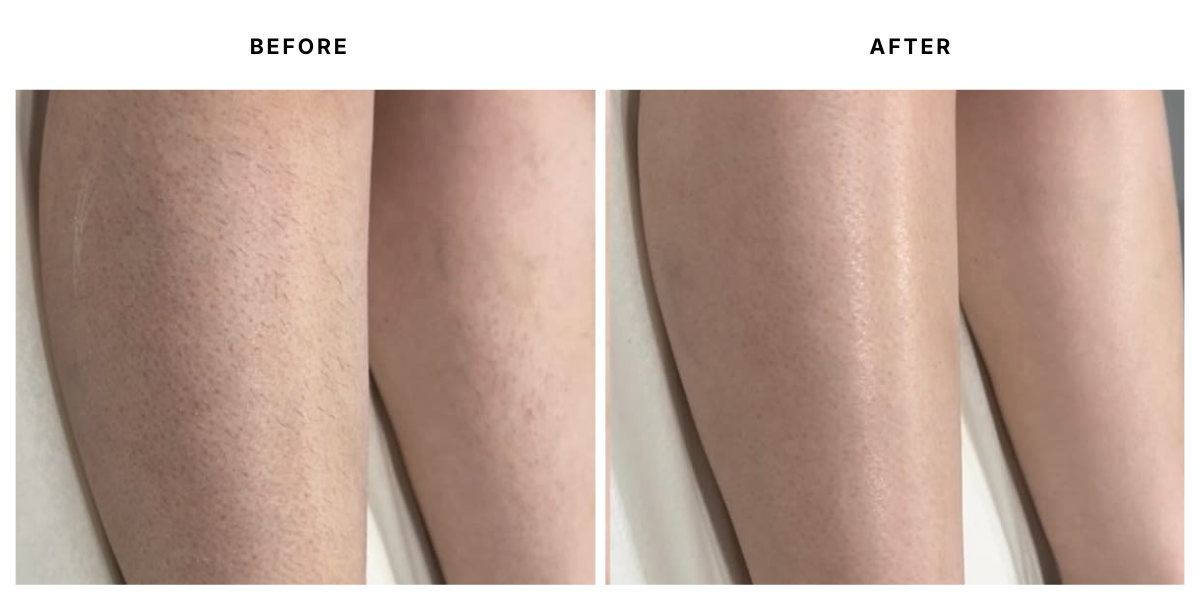  Before and after laser hair removal results at Laser &amp; Skin Medical in Edgewater, Miami 