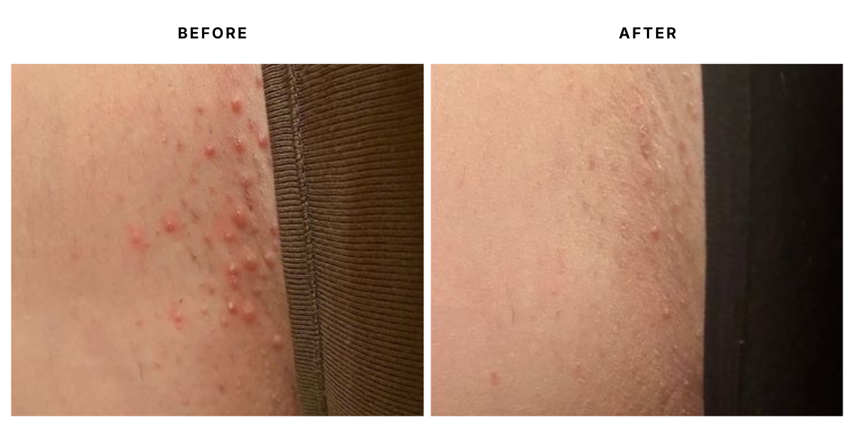 Before and after skin treatment results at Laser &amp; Skin Medical in Edgewater, Miami 