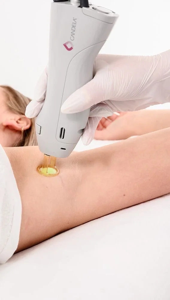 Underarm laser hair removal treatment using medical-grade technology