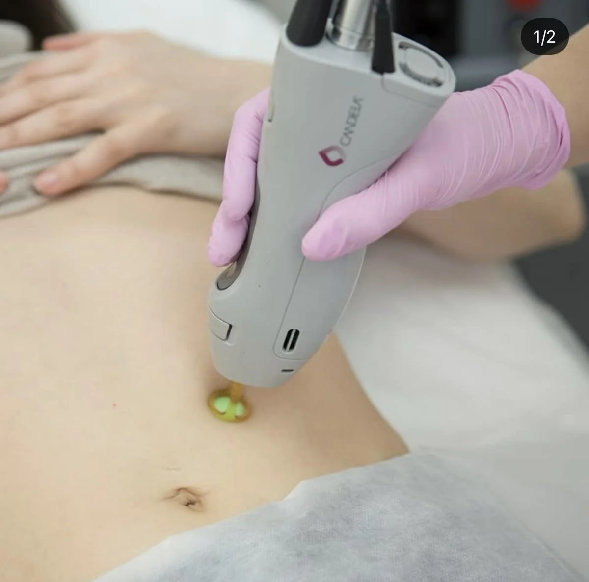Laser hair removal treatment using Candela technology on abdomen area