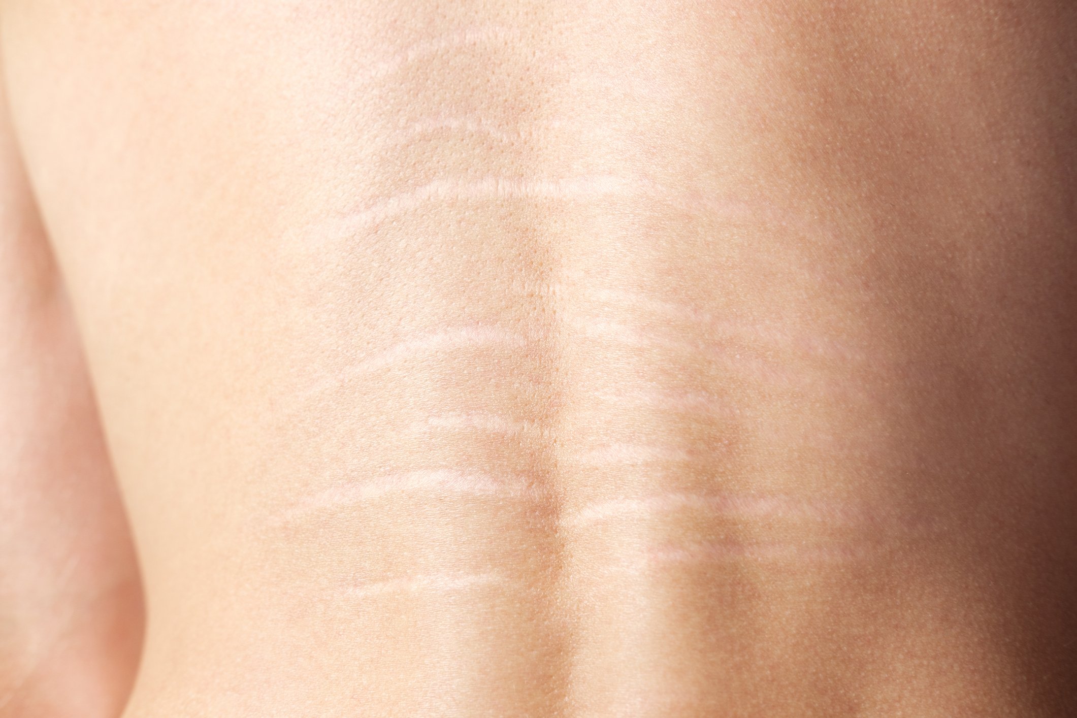 Close-up of a person's smooth, light-colored skin with a stretch marks.
