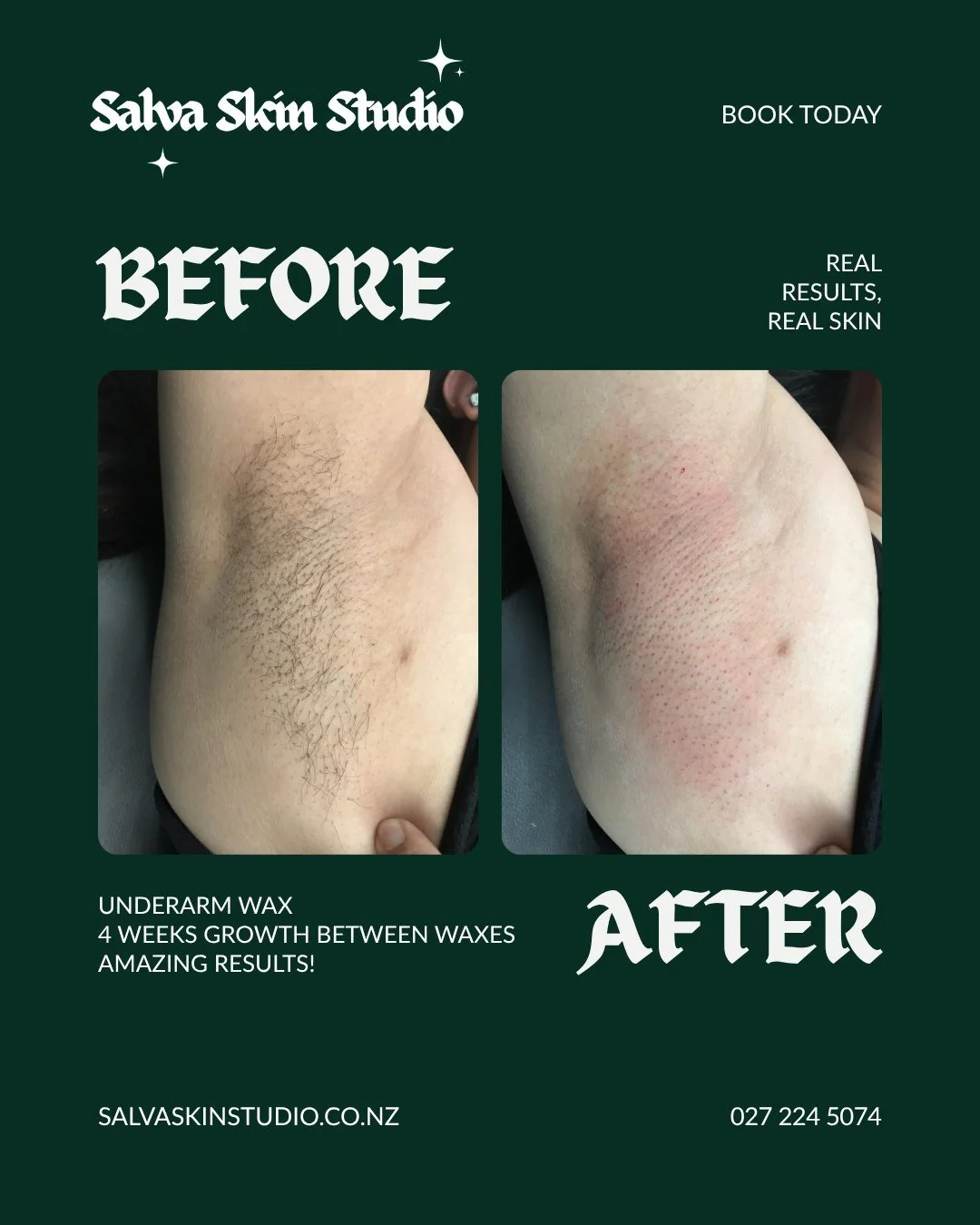 Real results, real skin.

Underarm wax &mdash; before and after. This client had 4 weeks of growth between waxes and the results speak for themselves.

Smooth, clean, and so much better than shaving. With regular waxing the hair grows back finer and 