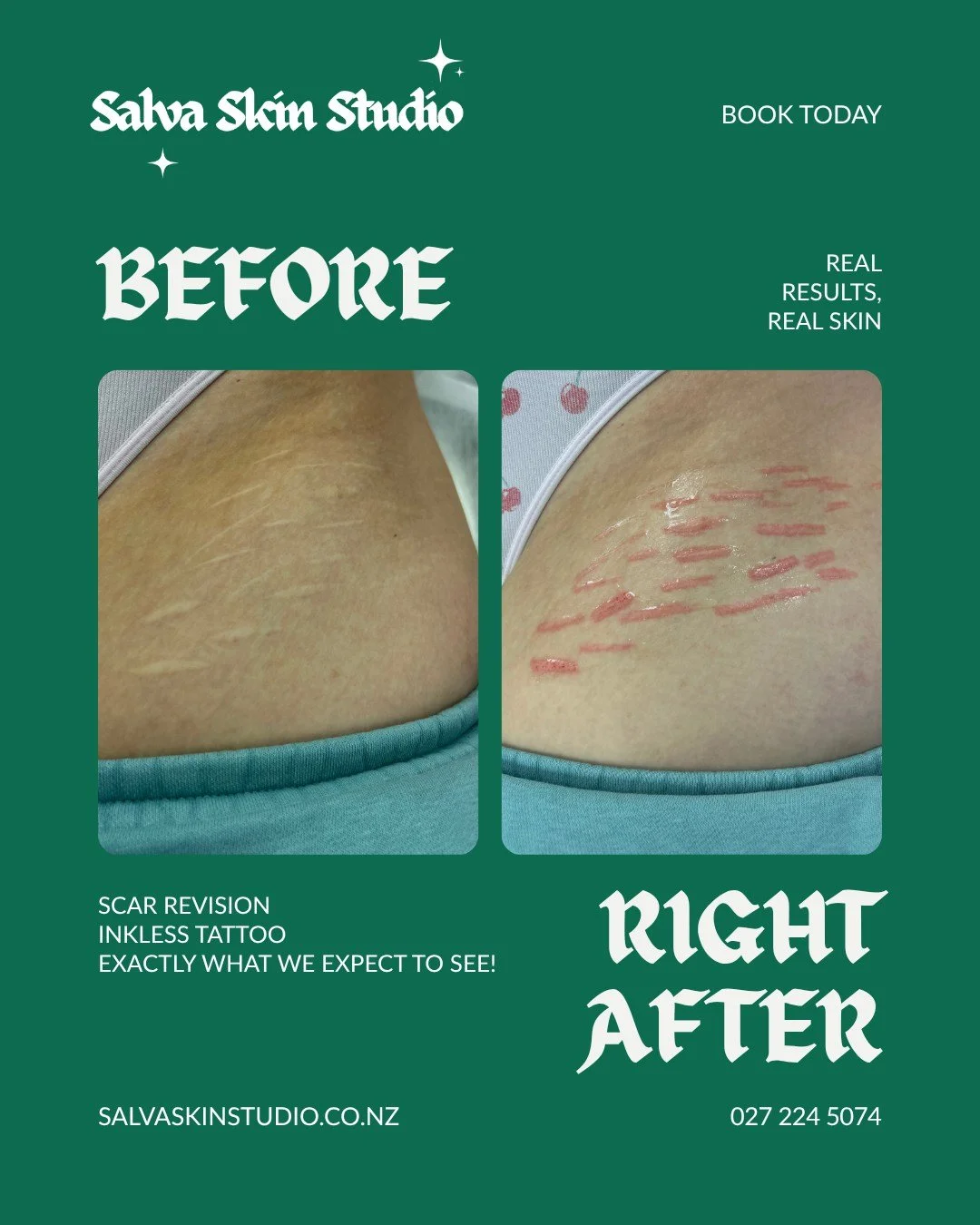 Real results, real skin.

This is an inkless scar revision &mdash; no pigment, just our medical-grade Nue Regen serum needled into the skin to stimulate healing and smooth the texture of these scars.

The right photo is immediately after treatment, s