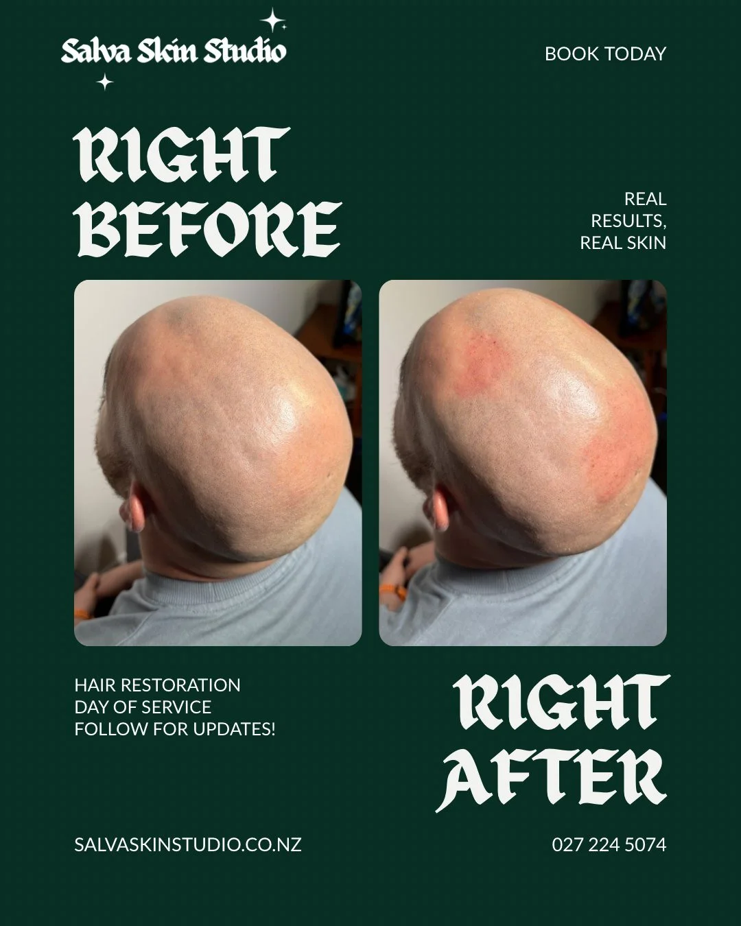 This client has started shaving his head because of the thinning areas. 

We used NUE Strand on the thinning areas. 

Swipe to see after two days, he is starting to grow hair in those thinning areas

Follow to see the two week progress!

Book your se