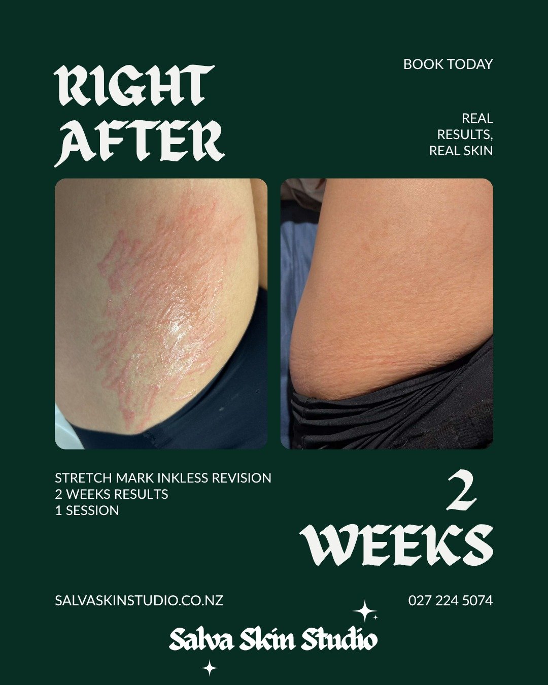 Fresh update! 

This lovely client received Inkless revision on her thigh stretch marks. 

This is just after the treatment which can look scary at a glance but look at the beautiful results after just two weeks! 

She still has 6 weeks to fully heal