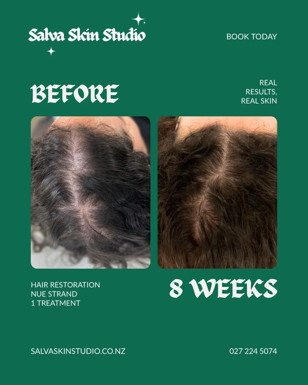 Treatment: Hair Restoration - half head
8 week results

These are my personal results and my personal why. I have been self conscious about my hair for a long time. After having my son, I had a hard time with hormonal hair loss and have never quite g