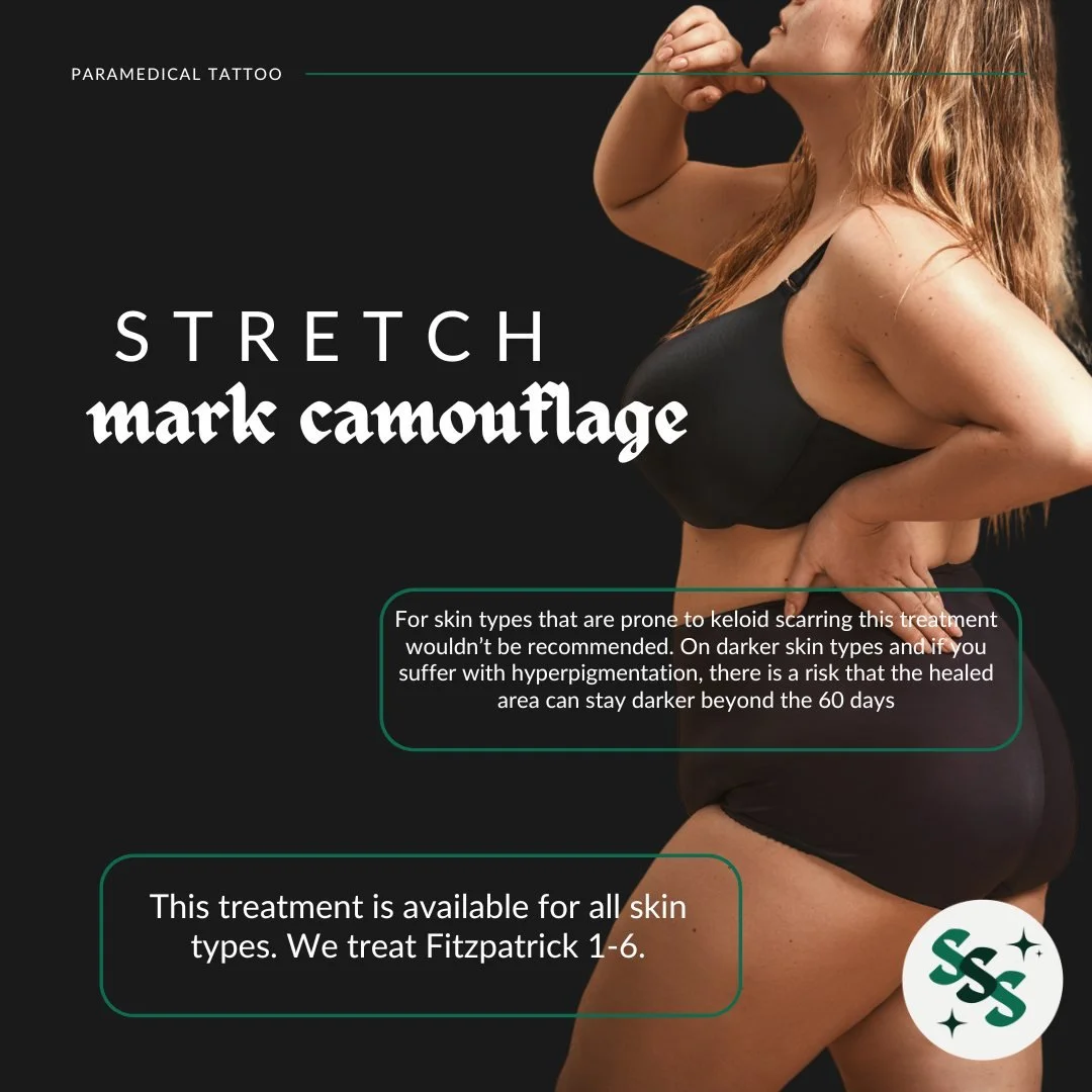 Stretch mark camouflage is available for all skin types &mdash; we treat Fitzpatrick 1&ndash;6. 

For skin types prone to keloid scarring, this treatment wouldn't be recommended. On darker skin types with hyperpigmentation, there is a risk that the h