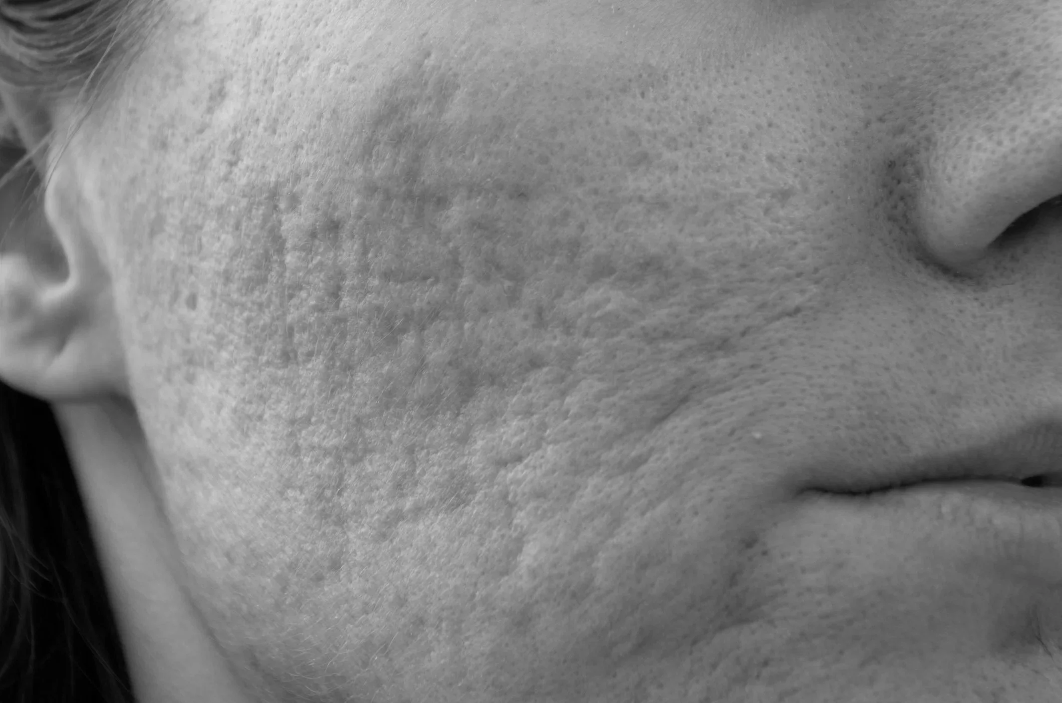 Close-up black and white photograph of a person's face, focusing on their lips and part of the nose. The skin texture and facial features are visible.