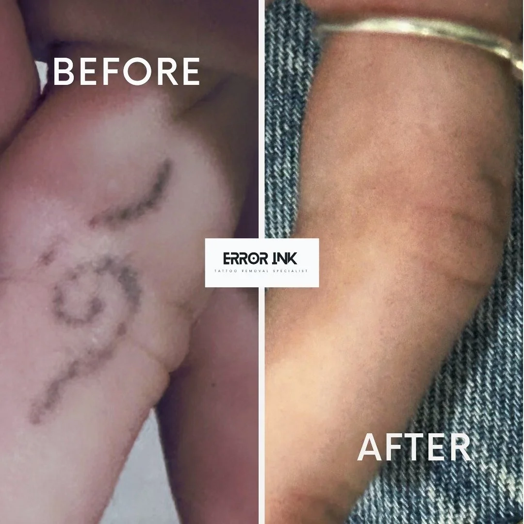 Amazing before and after of our client&rsquo;s full tattoo removal journey with us at Error Ink Tattoo Removal. From bold ink to a clean slate, our advanced Super Picosecond technology and personalised care have made this transformation possible.

💪