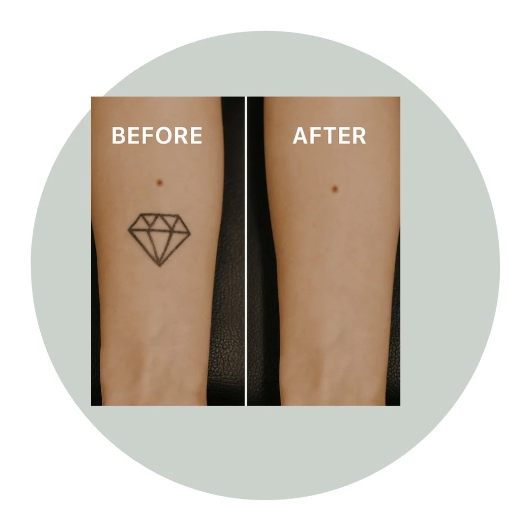 Ready to say goodbye to unwanted ink? Discover how advanced laser technology makes tattoo removal effective and comfortable! 💥 Book Now!